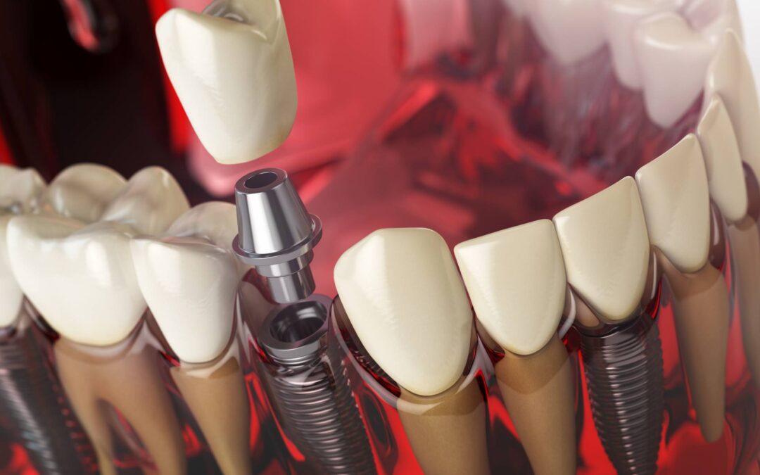 Mini-İmplantlar için Optimal Konumları Belirlemek.